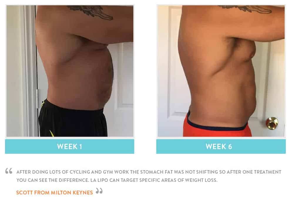 Before & After Stomach Fat Burgess Hill