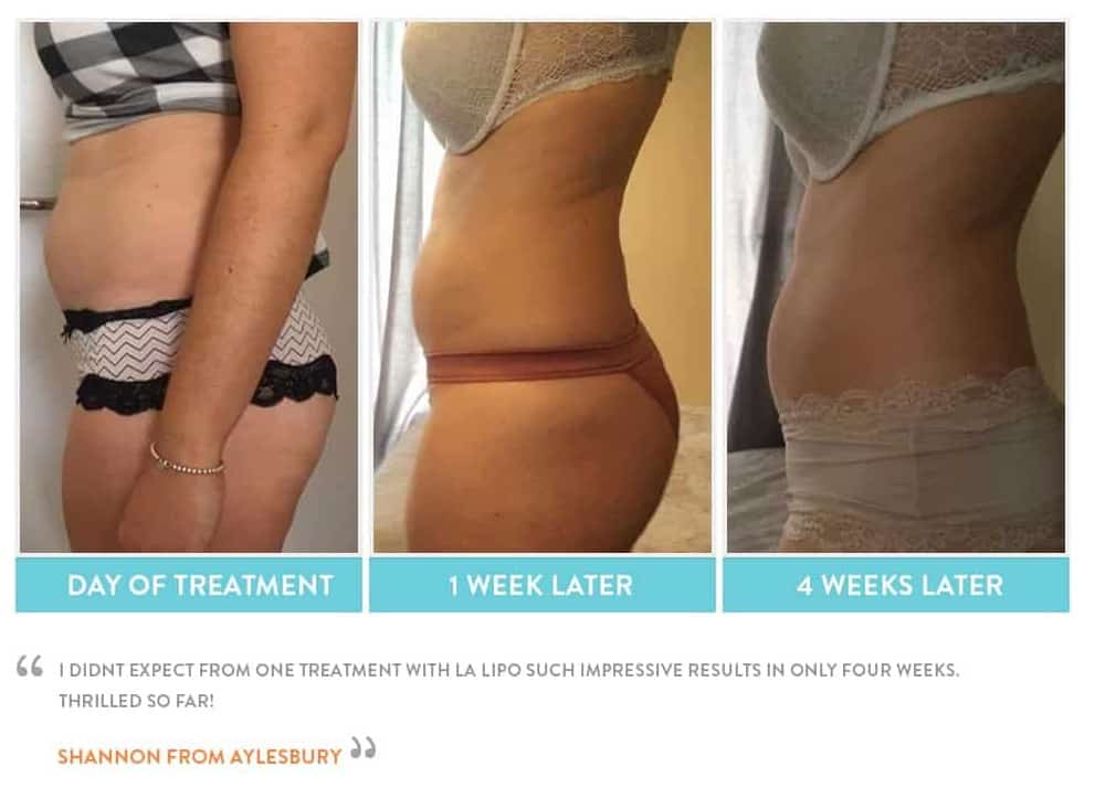 before, Cryolipolysis Burgess Hill
