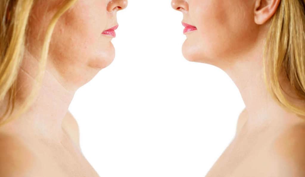 Double Chin treatment Burgess Hill before and after results