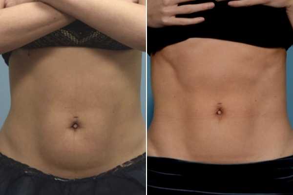body sculpting FAQs Burgess Hill