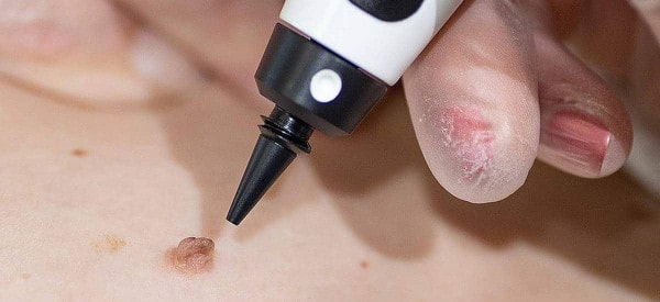 After Skin Tag Removal Burgess Hill