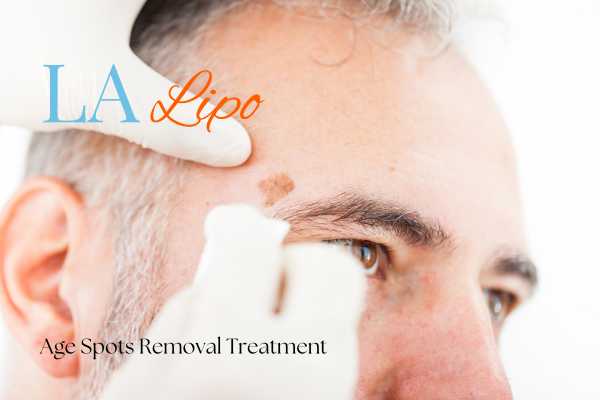 What Are the Most Effective Treatments for Age Spots Burgess Hill?