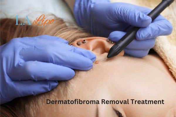 Dermatofibroma Removal Treatment Burgess Hill