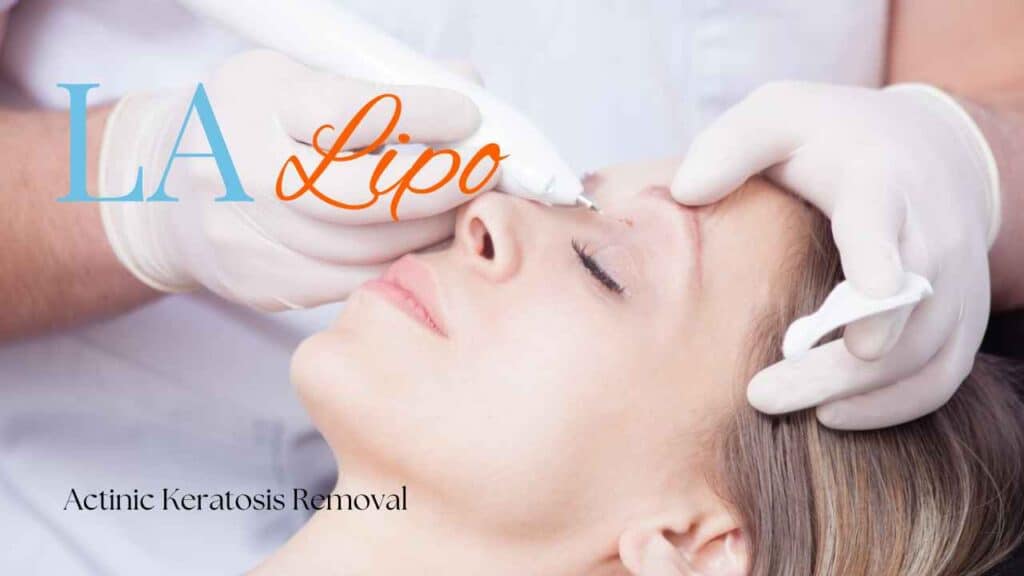 actinic keratosis removal Burgess Hill
