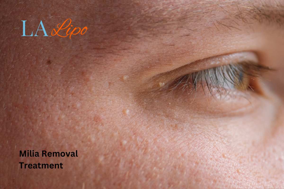 Cryopen Milia Removal: Is It the Easiest and Safest Option Burgess Hill?