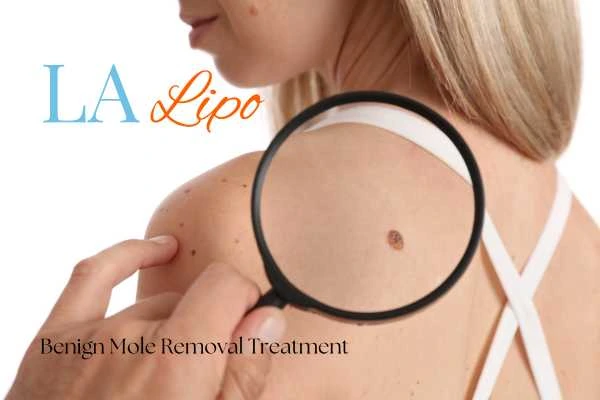 Woman having her inspection of blemish before mole removal Burgess Hill