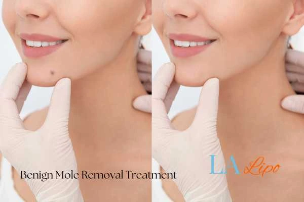 woman's before and after mole removal Burgess Hill results