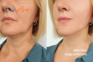 hi-fu for wrinkles Burgess Hill before and after results