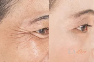 Before and after results of woman - HI-fu wrinkles reduction treatment Burgess Hill