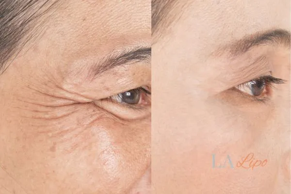 Before and after results of woman - HI-fu wrinkles reduction treatment Burgess Hill
