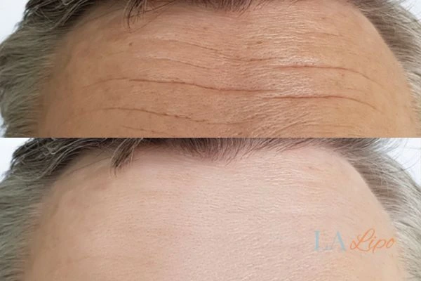 results of HIFU Burgess Hill on mans forehead to help reduce lines and wrinkles