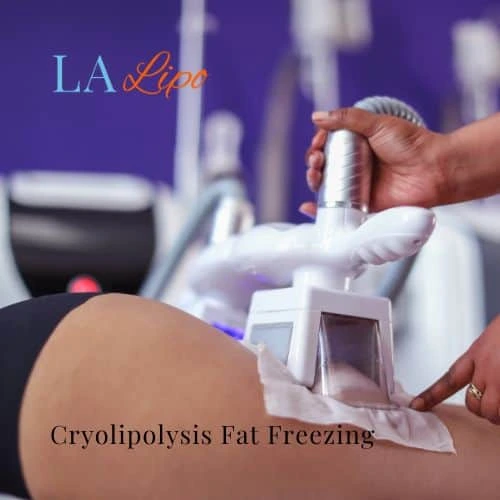 fat freezing - Cryolipolysis Burgess Hill