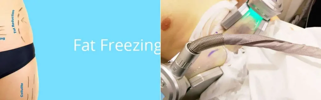 Fat freezing Burgess Hill on multiple areas of the body