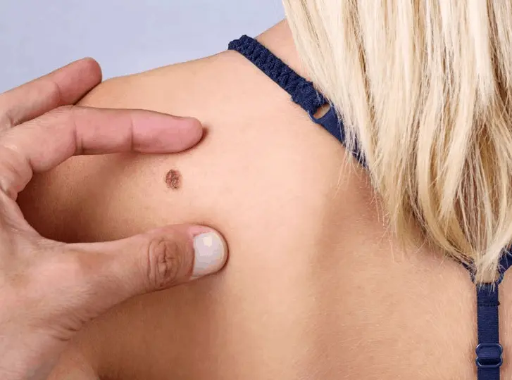 woman having mole removal Burgess Hill consultation before treatment.