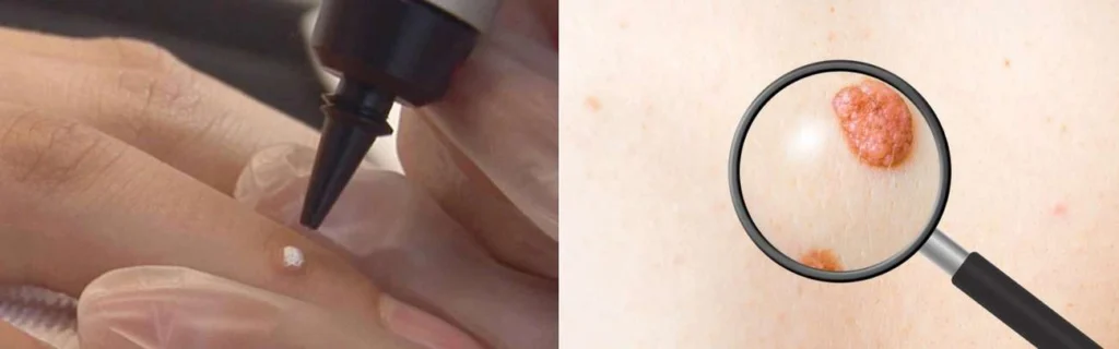 Person getting moles removed with cryopen Burgess Hill