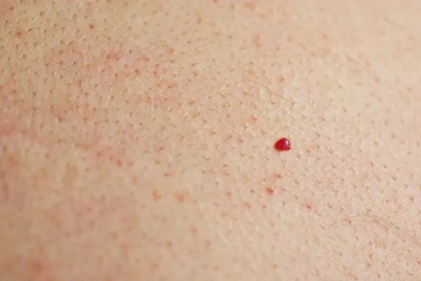 close up of a cherry angioma Burgess Hill