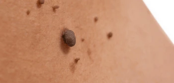 image of a skin tag Burgess Hill
