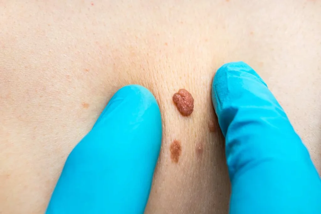 Consultant examining a skin tag Burgess Hill