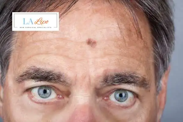 Solar Lentigo Removal Burgess Hill image of man with mark on his forehead