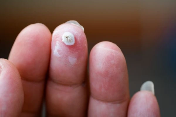 wart on person finger - cryotherapy to treat from LA LIPO Burgess Hill