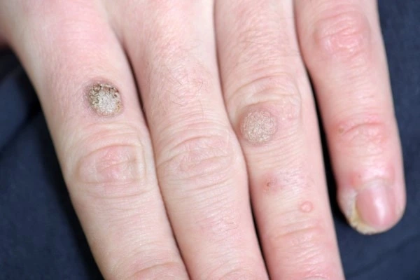 photo of warts on person hand - see wart removal Burgess Hill from LA LIPO