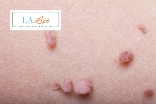 Does cryopen skin tag removal Burgess Hill hurt? Find out now call our team today!