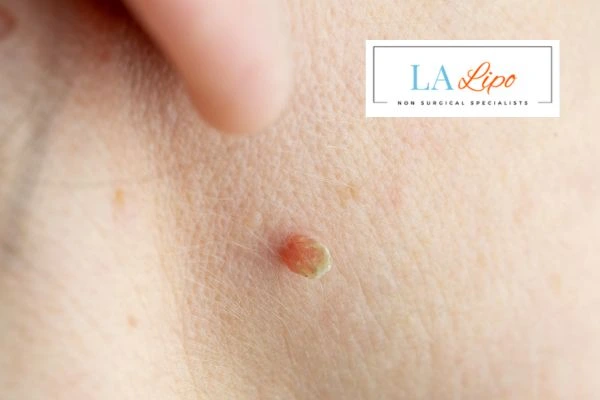 Book skin tag removal Burgess Hill today speak to our team now!