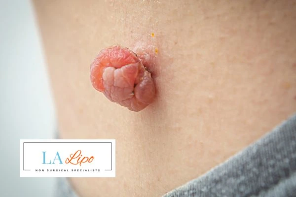 Interested in skin tag removal Burgess Hill? Concerned about the pain? Find out more today!