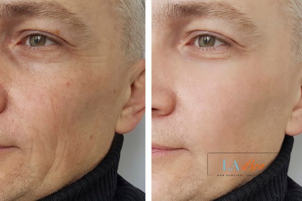 See the amazing results of Morpheus8 Treatment Burgess Hill!