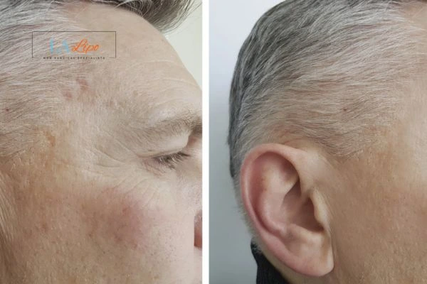 Mens Before & After Morpheus 8 Results Burgess Hill