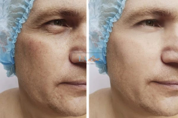 Before and after Morpheus 8 Results Burgess Hill