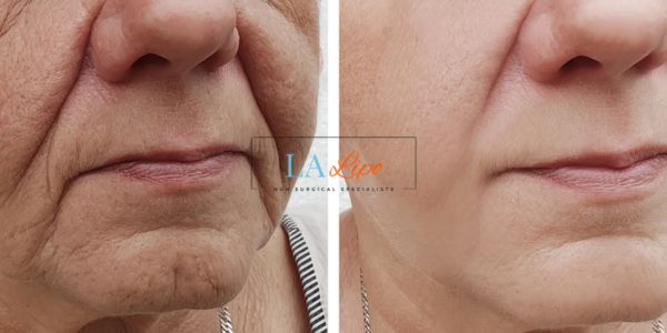 Older lady deeper wrinkle reduction - LA LIPO Morpheus 8 Results Burgess Hill