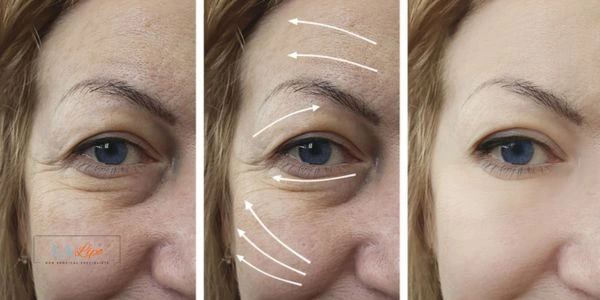 Amazing eye lift Morpheus 8 results Burgess Hill