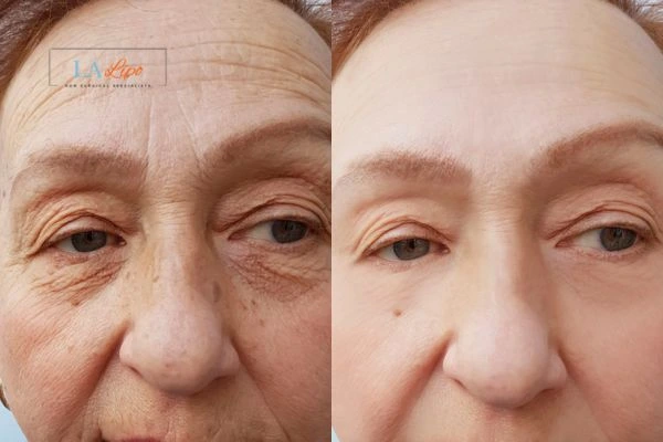 The powerful benefits of Morpheus8 Treatment Burgess Hill - Call Our team today!
