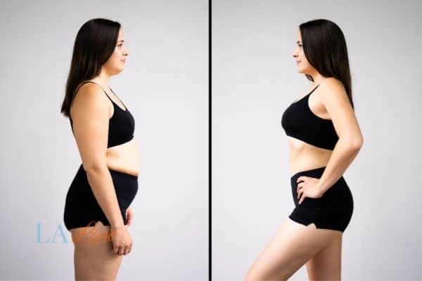 Picture of womans before and after using LA-EMS body sculpting to improve her core strength Burgess Hill