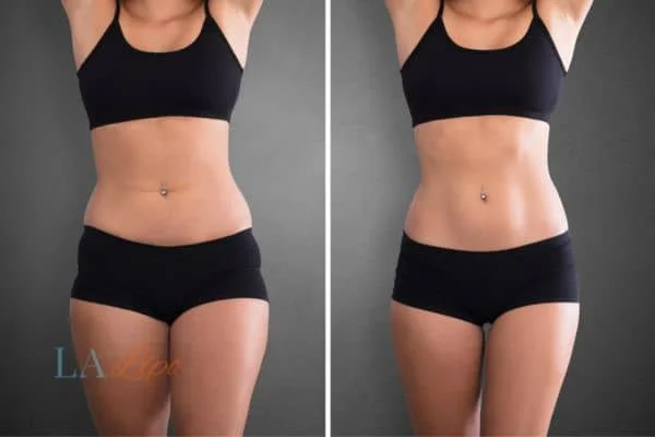 before and after results of non-surgical treatment to help a woman's body image and mental health Burgess Hill