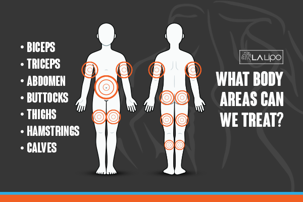 Diagram to show areas you can have LA-EMS Body Sculpting Treatment Burgess Hill