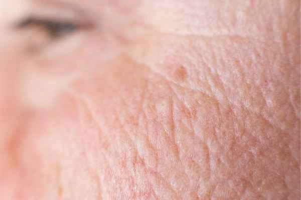 close up picture of a woman's face showing an age spot Burgess Hill