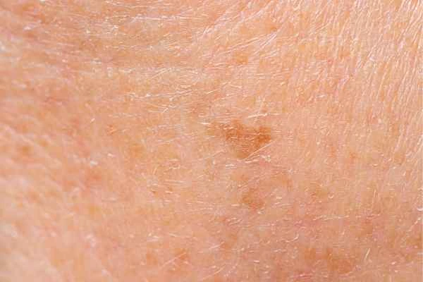 close up picture of age spots Burgess Hill