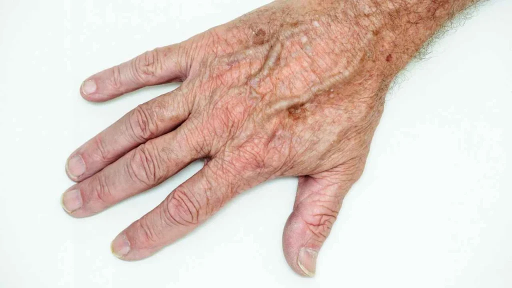Male hand showing age spot Burgess Hill