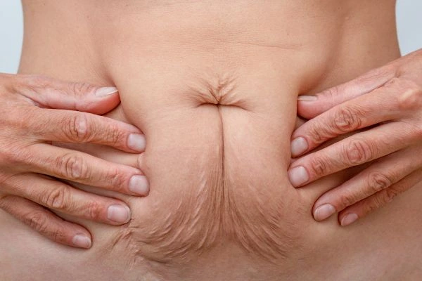 Image of a woman's stomach with loose skin - example of skin tightening Burgess Hill options