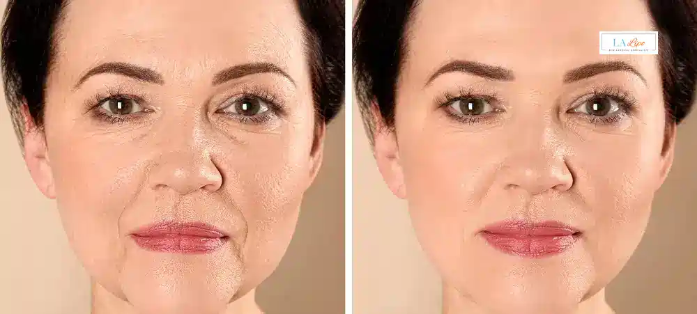 How Long Does It Take to See Results and How Long Do They Last Burgess Hill?